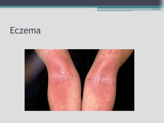 Eczema
 
