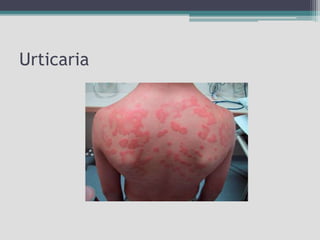 Urticaria
 