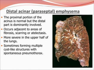 Distal acinar (paraseptal) emphysema
 The proximal portion of the
acinus is normal but the distal
part is dominantly involved.
 Occurs adjacent to areas of
fibrosis, scarring or atelectasis.
 More severe in the upper half of
the lungs.
 Sometimes forming multiple
cyst-like structures with
spontaneous pneumothorax.
 