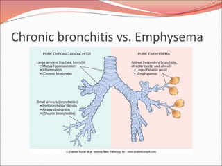 Chronic bronchitis vs. Emphysema
 