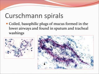 Curschmann spirals
 Coiled, basophilic plugs of mucus formed in the
lower airways and found in sputum and tracheal
washings
 