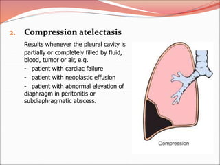 2. Compression atelectasis
Results whenever the pleural cavity is
partially or completely filled by fluid,
blood, tumor or air, e.g.
- patient with cardiac failure
- patient with neoplastic effusion
- patient with abnormal elevation of
diaphragm in peritonitis or
subdiaphragmatic abscess.
 