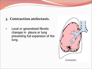 3. Contraction atelectasis.
 Local or generalized fibrotic
changes in pleura or lung
preventing full expansion of the
lung.
 