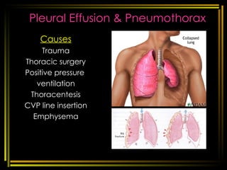 Pleural Effusion & Pneumothorax Causes Trauma Thoracic surgery Positive pressure  ventilation Thoracentesis CVP line insertion Emphysema [email_address] respi disorders 