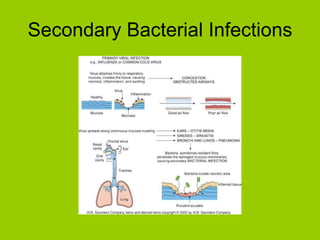 Secondary Bacterial Infections 