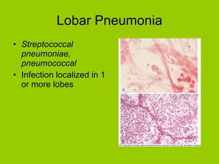 Lobar Pneumonia Streptococcal pneumoniae, pneumococcal Infection localized in 1 or more lobes 