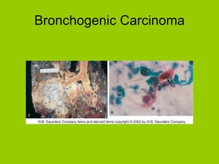 Bronchogenic Carcinoma 