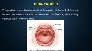 PHARYNGITIS
Pharyngitis is a sore throat caused by inflammation of the back of the throat
between the tonsils and the larynx. (Also called the Pharynx) which usually
subsides within a week or Less.
 