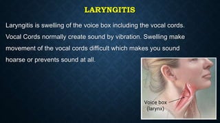LARYNGITIS
Laryngitis is swelling of the voice box including the vocal cords.
Vocal Cords normally create sound by vibration. Swelling make
movement of the vocal cords difficult which makes you sound
hoarse or prevents sound at all.
 