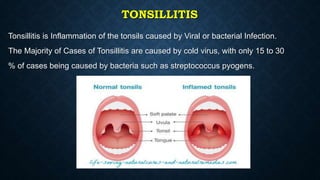 TONSILLITIS
Tonsillitis is Inflammation of the tonsils caused by Viral or bacterial Infection.
The Majority of Cases of Tonsillitis are caused by cold virus, with only 15 to 30
% of cases being caused by bacteria such as streptococcus pyogens.
 