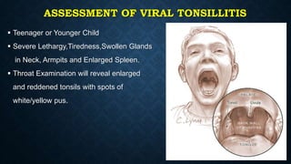 ASSESSMENT OF VIRAL TONSILLITIS
 Teenager or Younger Child
 Severe Lethargy,Tiredness,Swollen Glands
in Neck, Armpits and Enlarged Spleen.
 Throat Examination will reveal enlarged
and reddened tonsils with spots of
white/yellow pus.
 