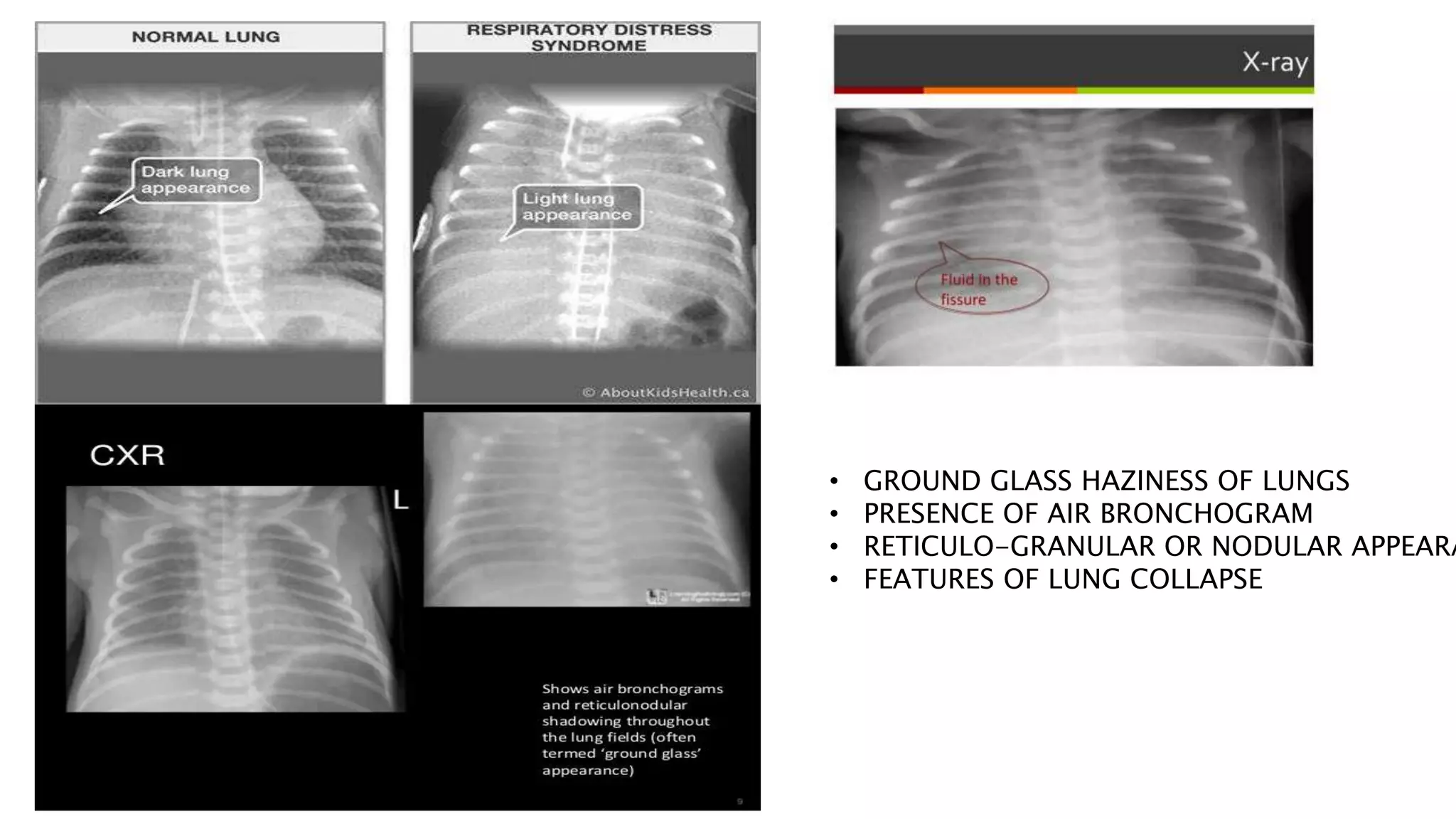 Respiratory Distress In Neonates pptx