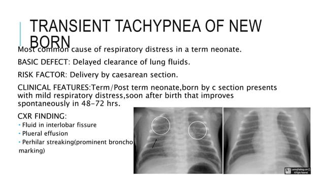 Respiratory distress in neonates.pptx | Lung and Respiratory Health ...