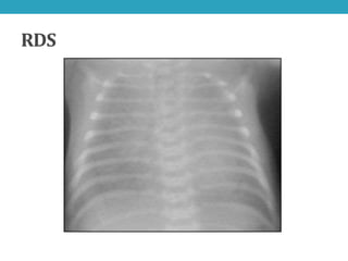 Respiratory distress in newborn | PPTX