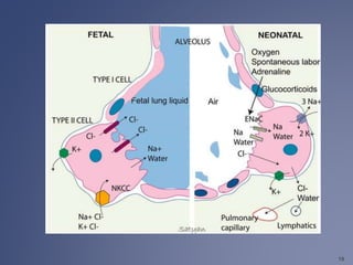 Respiratory distress of the newborn | PPTX