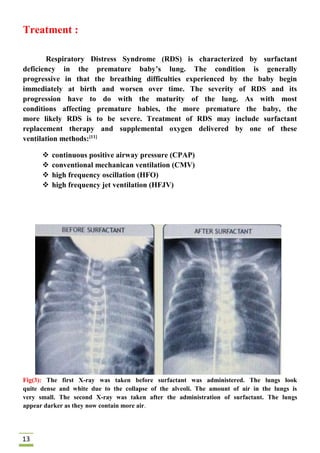 Respiratory distress syndrome 2018 | PDF