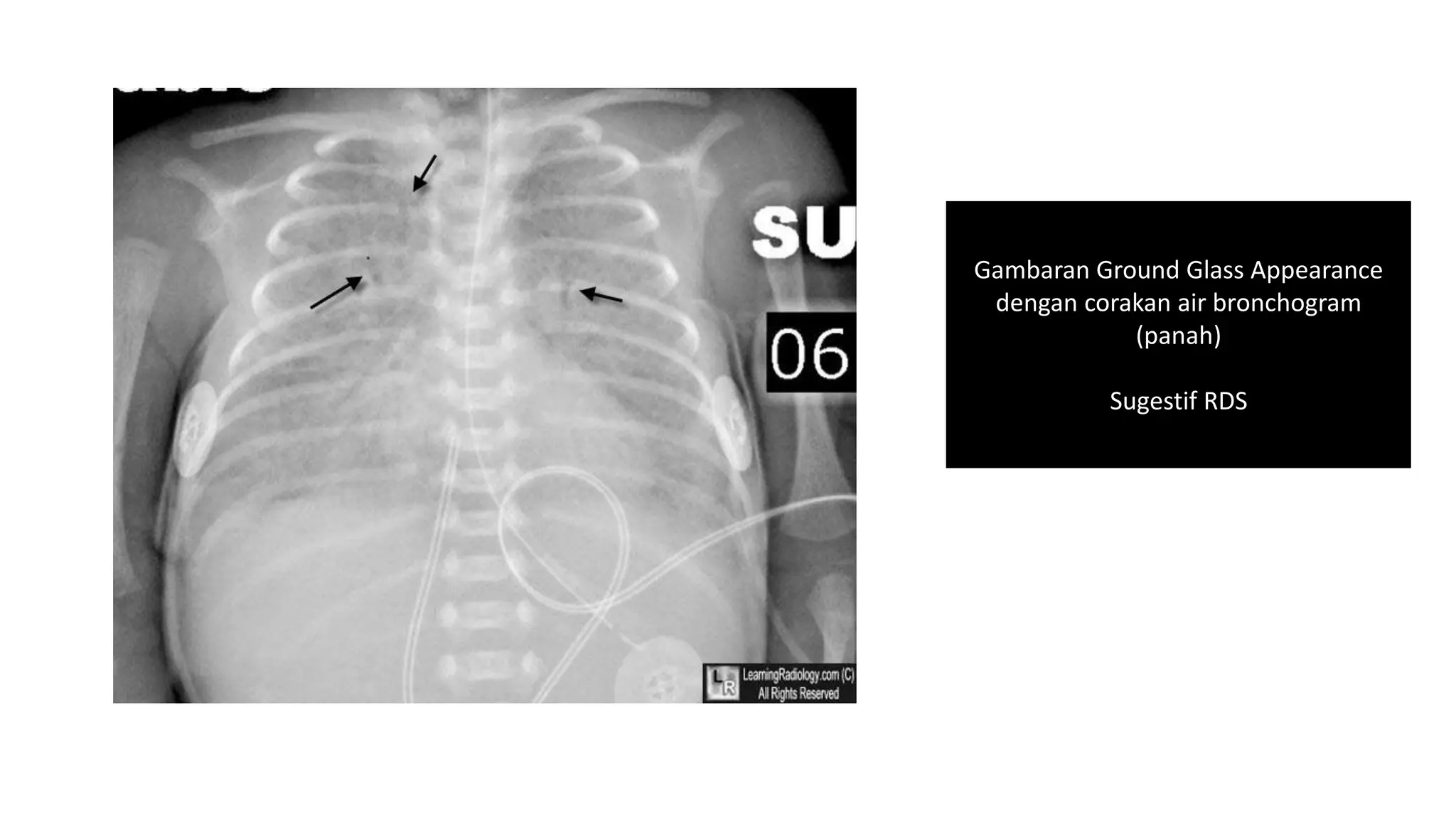 Air Bronchogram Rds Respiratory Distress Syndrome (RDS).pptx