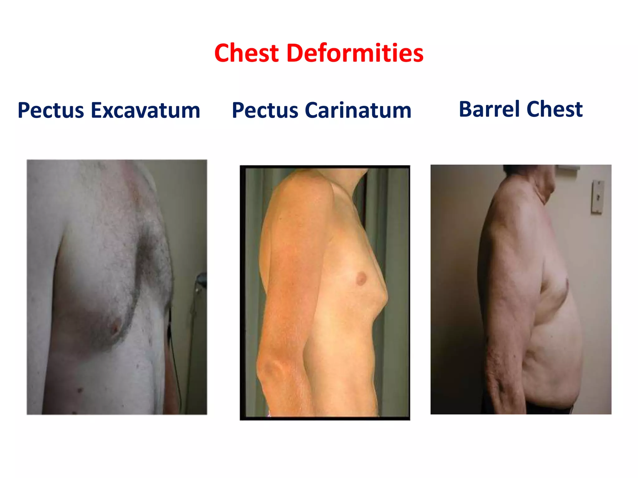 Pectus Types Respiratory examination | PPTX | Lung and Respiratory Health | Diseases ...
