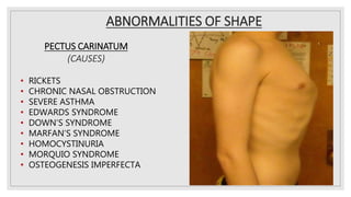 ABNORMALITIES OF SHAPE
PECTUS CARINATUM
(CAUSES)
• RICKETS
• CHRONIC NASAL OBSTRUCTION
• SEVERE ASTHMA
• EDWARDS SYNDROME
• DOWN’S SYNDROME
• MARFAN’S SYNDROME
• HOMOCYSTINURIA
• MORQUIO SYNDROME
• OSTEOGENESIS IMPERFECTA
 