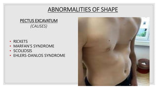 ABNORMALITIES OF SHAPE
PECTUS EXCAVATUM
(CAUSES)
• RICKETS
• MARFAN’S SYNDROME
• SCOLIOSIS
• EHLERS-DANLOS SYNDROME
 