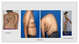 SCOLIOSIS
KYPHOSIS
HYPER LORDOSIS
 