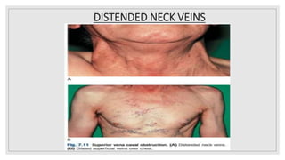 DISTENDED NECK VEINS
 