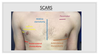 SCARS
 