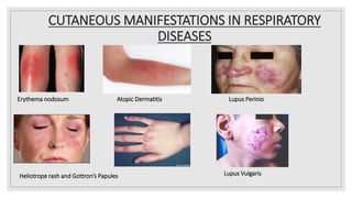 CUTANEOUS MANIFESTATIONS IN RESPIRATORY
DISEASES
Erythema nodosum Atopic Dermatitis Lupus Perinio
Heliotrope rash and Gottron’s Papules Lupus Vulgaris
 
