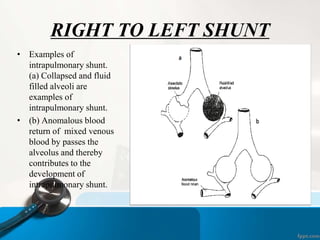RIGHT TO LEFT SHUNT
• Examples of
intrapulmonary shunt.
(a) Collapsed and fluid
filled alveoli are
examples of
intrapulmonary shunt.
• (b) Anomalous blood
return of mixed venous
blood by passes the
alveolus and thereby
contributes to the
development of
intrapulmonary shunt.
 