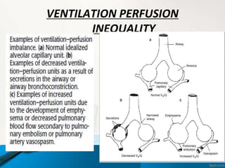 VENTILATION PERFUSION
INEQUALITY
 