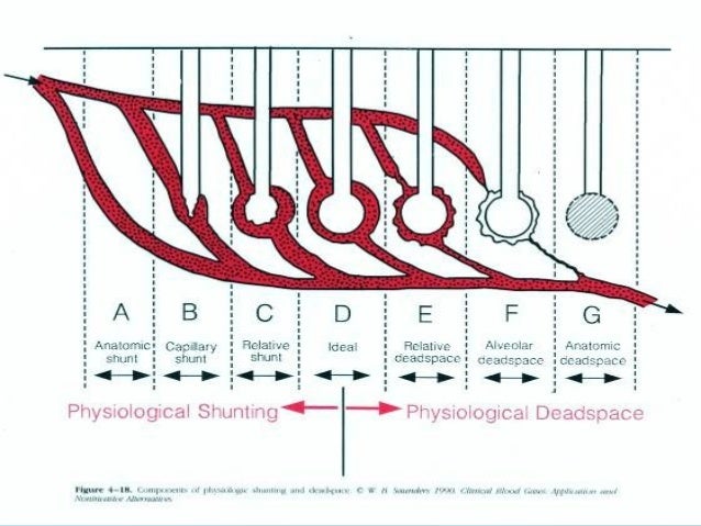 alveolar arterial gradient shunt vs. dead space ventilation alveolar arterial gradient shunt vs. dead space ventilation