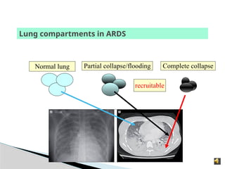 Lung compartments in ARDS
Normal lung Partial collapse/flooding Complete collapse
recruitable
 