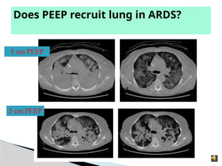 Does PEEP recruit lung in ARDS?
5 cm PEEP
5 cm PEEP
 