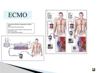 ECMO
 
