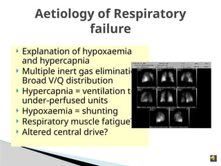 Aetiology of Respiratory
failure
 Explanation of hypoxaemia
and hypercapnia
 Multiple inert gas elimination
Broad V/Q distribution
 Hypercapnia = ventilation to
under-perfused units
 Hypoxaemia = shunting
 Respiratory muscle fatigue?
 Altered central drive?
 