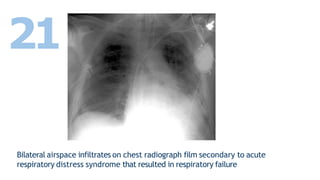 Bilateral airspace infiltrates on chest radiograph film secondary to acute
respiratory distress syndrome that resulted in respiratory failure
21
 