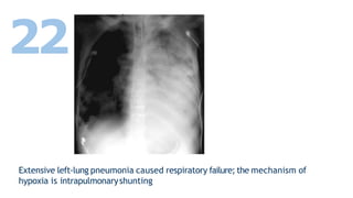 Extensive left-lung pneumonia caused respiratory failure; the mechanism of
hypoxia is intrapulmonaryshunting
22
 