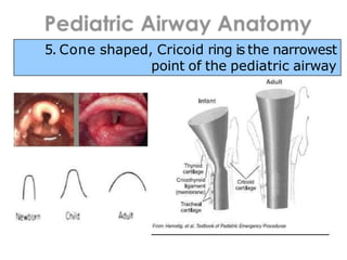5. Cone shaped, Cricoid ring is the narrowest
point of the pediatric airway
 
