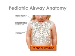 Tracheal Position
 