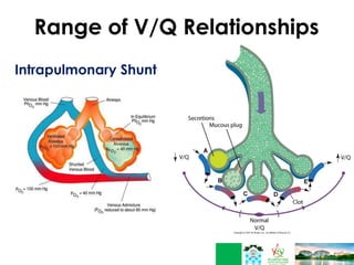 Range of V/Q Relationships
Intrapulmonary Shunt
 