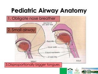 Pediatric Airway Anatomy
1. Obligate nose breather
2. Small airway
3.Disproportionally bigger tongues
 