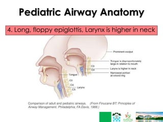 Pediatric Airway Anatomy
4. Long, floppy epiglottis, Larynx is higher in neck
 