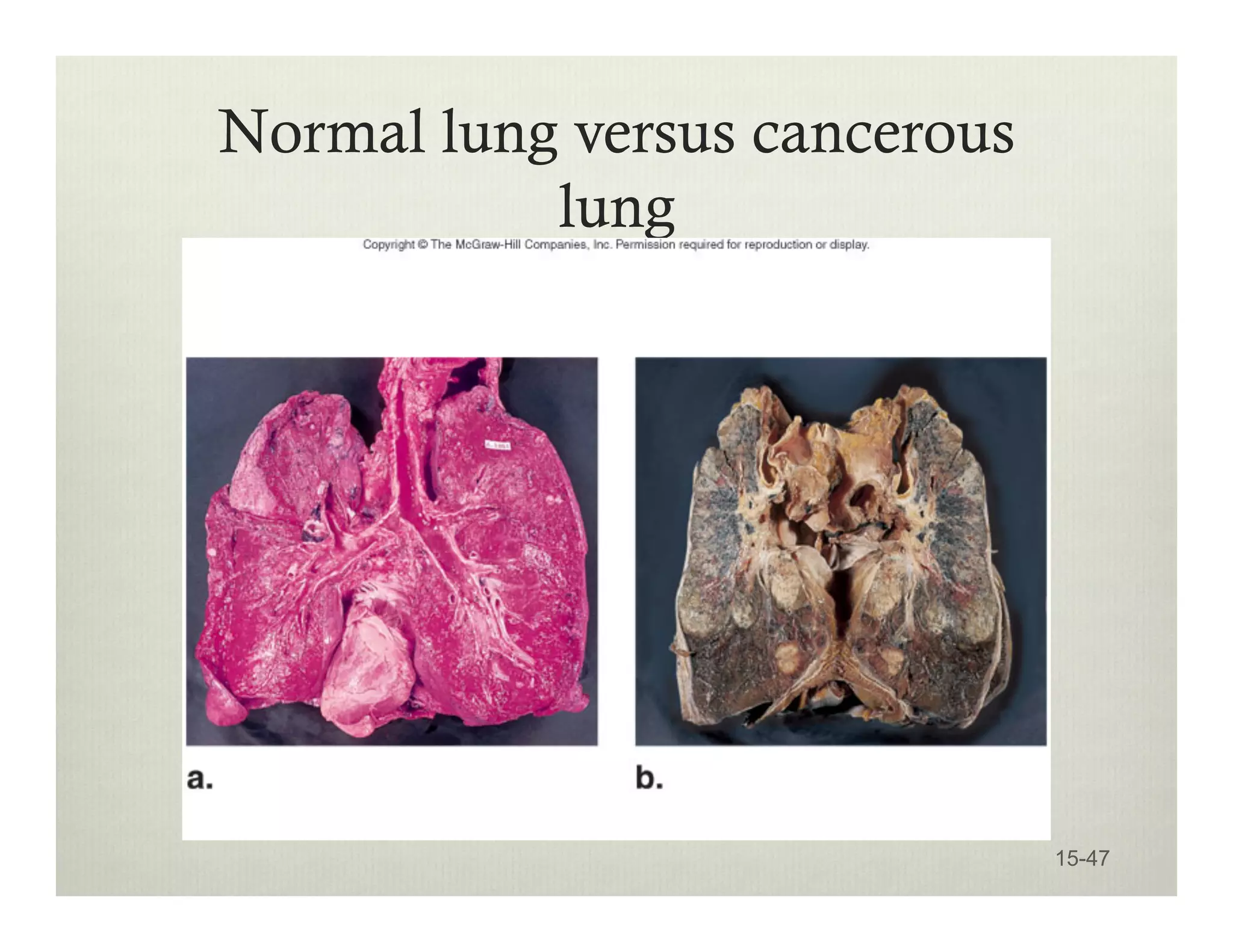 Normal lung versus cancerous
lung
15-47
 