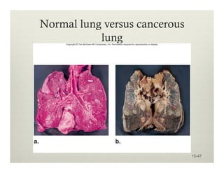 Normal lung versus cancerous
lung
15-47
 