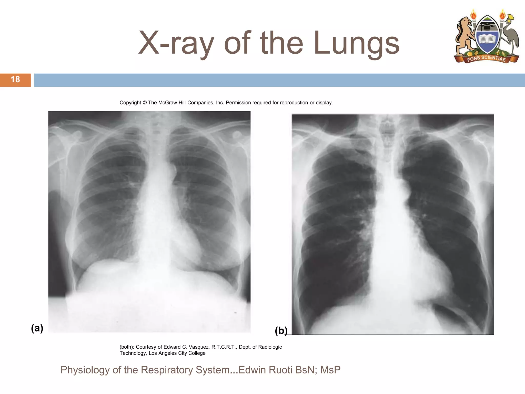X-ray of the Lungs
(a) (b)
Copyright © The McGraw-Hill Companies, Inc. Permission required for reproduction or display.
(both): Courtesy of Edward C. Vasquez, R.T.C.R.T., Dept. of Radiologic
Technology, Los Angeles City College
18
Physiology of the Respiratory System...Edwin Ruoti BsN; MsP
 