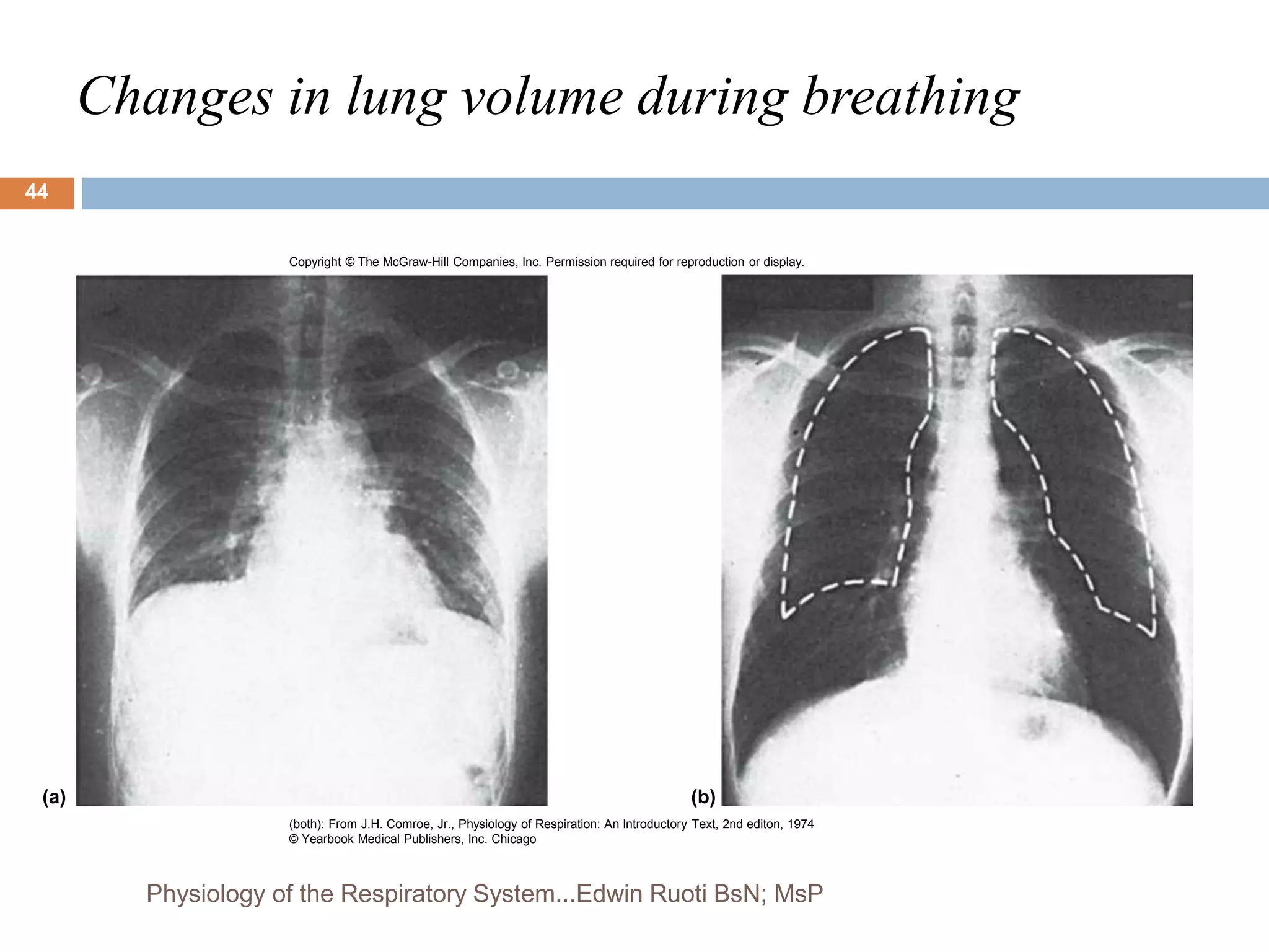 Changes in lung volume during breathing
Copyright © The McGraw-Hill Companies, Inc. Permission required for reproduction or display.
(b)
(a)
(both): From J.H. Comroe, Jr., Physiology of Respiration: An Introductory Text, 2nd editon, 1974
© Yearbook Medical Publishers, Inc. Chicago
44
Physiology of the Respiratory System...Edwin Ruoti BsN; MsP
 