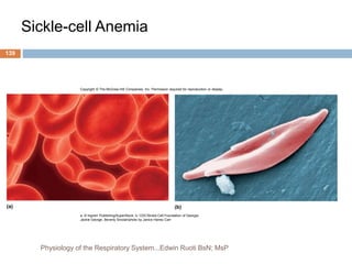 Sickle-cell Anemia
(a) (b)
Copyright © The McGraw-Hill Companies, Inc. Permission required for reproduction or display.
a: © Ingram Publishing/SuperStock; b: CDC/Sickle Cell Foundation of Georgia:
Jackie George, Beverly Sinclair/photo by Janice Haney Carr
139
Physiology of the Respiratory System...Edwin Ruoti BsN; MsP
 