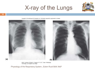X-ray of the Lungs
(a) (b)
Copyright © The McGraw-Hill Companies, Inc. Permission required for reproduction or display.
(both): Courtesy of Edward C. Vasquez, R.T.C.R.T., Dept. of Radiologic
Technology, Los Angeles City College
18
Physiology of the Respiratory System...Edwin Ruoti BsN; MsP
 