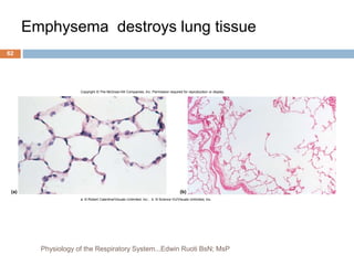 Emphysema destroys lung tissue
Copyright © The McGraw-Hill Companies, Inc. Permission required for reproduction or display.
(b)
(a)
a: © Robert Calentine/Visuals Unlimited, Inc.; b: © Science VU/Visuals Unlimited, Inc.
62
Physiology of the Respiratory System...Edwin Ruoti BsN; MsP
 