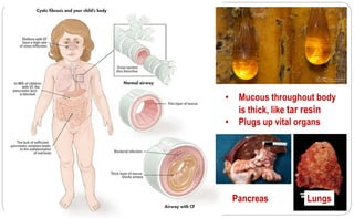 132
• Mucous throughout body
is thick, like tar resin
• Plugs up vital organs
Pancreas Lungs
 